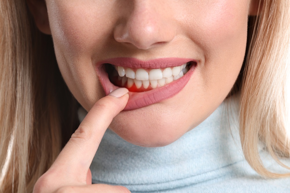 Treatment for Periodontitis: A Comprehensive Guide to Saving Your Teeth