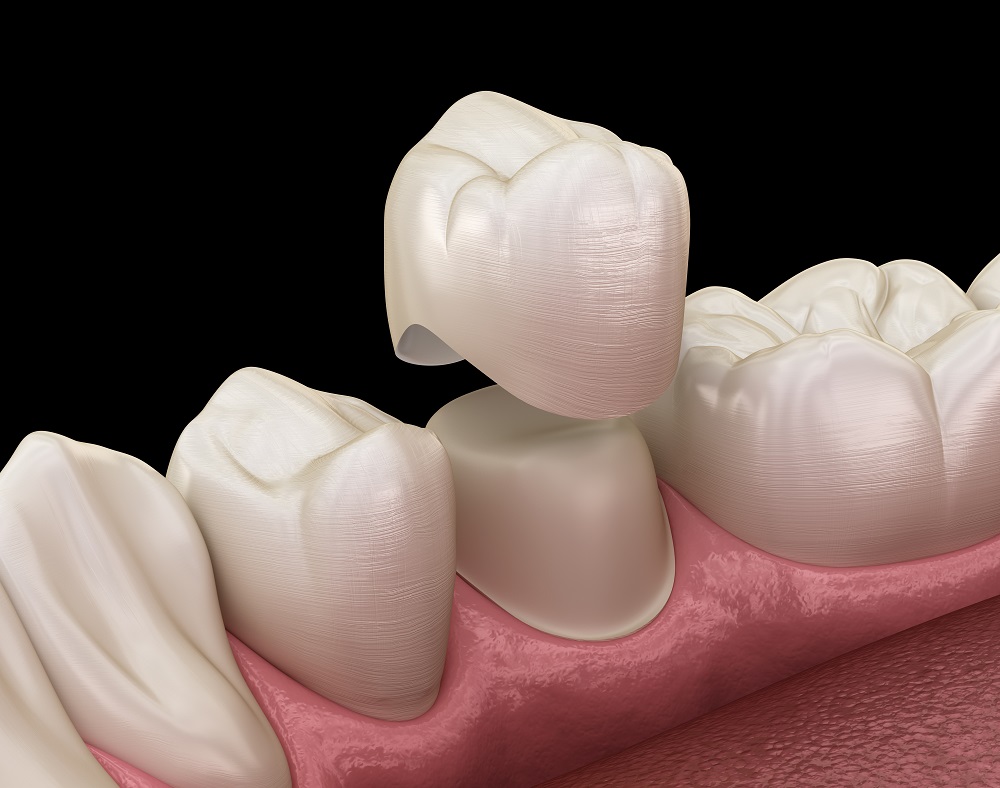 Things To Know About Dental Crowns